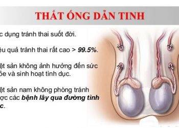 Tránh thai bằng biện pháp Thắt ống dẫn tinh có thực sự cần thiết?