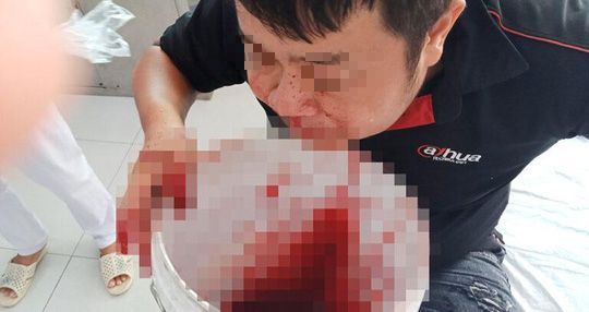 Cần Thơ: Bệnh nhân chảy máu mũi ồ ạt phải đem xô hứng may măn thoát chết