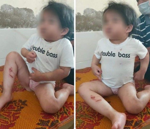 Hà Tĩnh: Bé gái 4 tuổi nhập viện nghi bị bạo hành