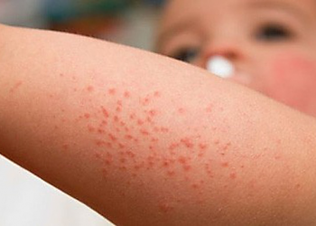 Trẻ sốt xuất huyết: Lưu ý từ ngày 3 đến ngày 7 của bệnh nếu không muốn con gặp nguy hiểm