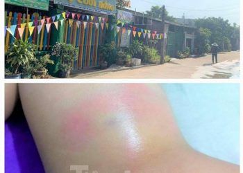 Bé gái 4 tuổi nghi bị cô giáo đánh bầm tím vì lý do khiến nhiều người bức xúc