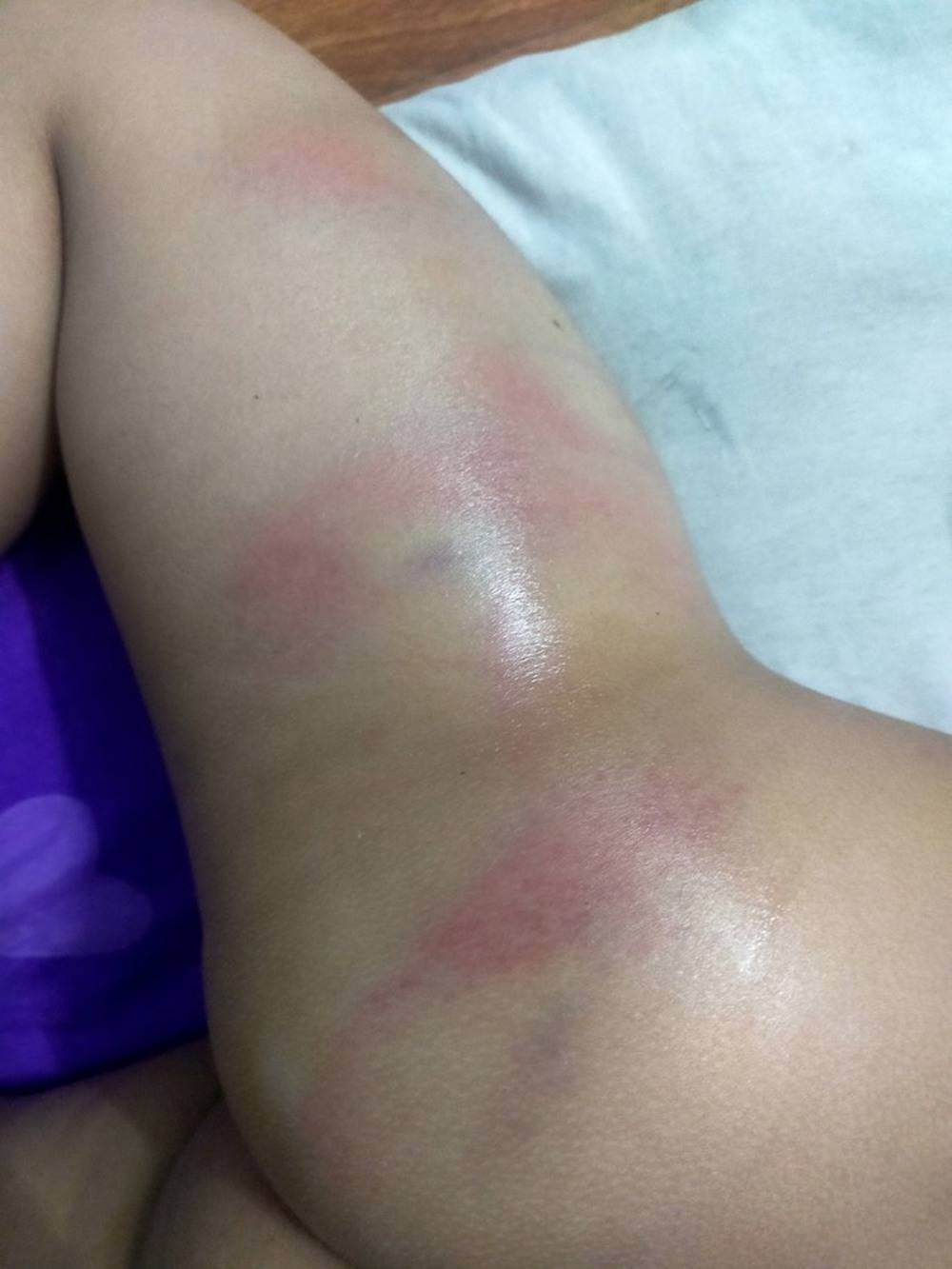 Công an vào cuộc việc bé gái 4 tuổi ở Bình Dương bị đánh bầm tím ở trường
