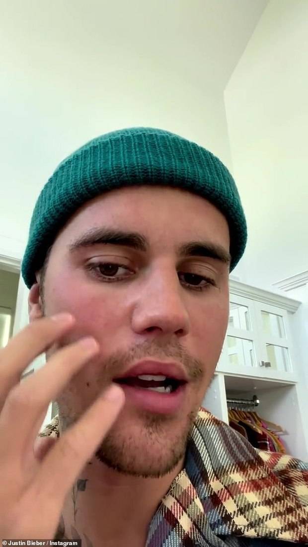 Justin Bieber bị liệt nửa mặt do nhiễm virus hiếm