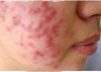 Mặt chi chít mụn sau dùng kem dưỡng ẩm mùa hè, bác sĩ chỉ ra sai lầm nhiều bạn gái trẻ mắc phải