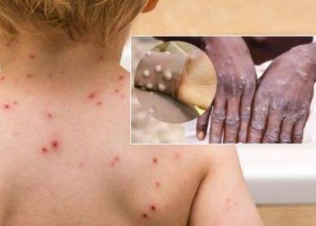 Triệu chứng điển hình của bệnh đậu mùa khỉ và cách điều trị