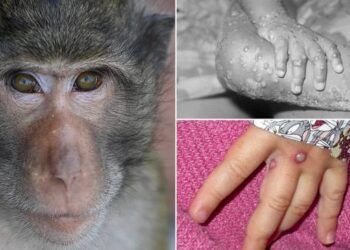 Bệnh đậu mùa khỉ: Bài học từ những điểm nóng và ứng phó của Việt Nam