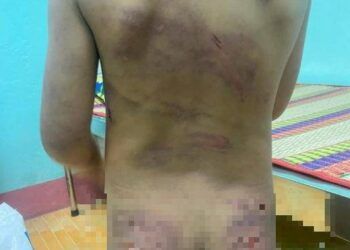 binh phuoc be gai nghi bi bao hanh voi nhieu vet thuong chi chit tren co the Bé gái 7 tuổi nghi bị bạo hành khi ở cùng mẹ và cha dượng khiến MXH dậy sóng Bình Phước: Bé gái nghi bị bạo hành với nhiều vết thương chi chít trên cơ thể