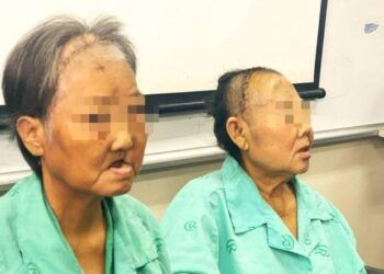 Chưa thể khẳng định nguyên nhân gây hoại tử xương hàm mặt là do COVID-19