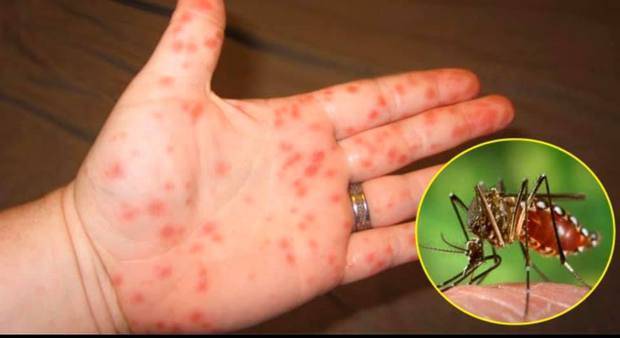 Đã có hơn 124.000 ca mắc, 40 người tử vong do sốt xuất huyết; dấu hiệu nguy hiểm của bệnh