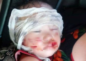 Đi chơi với mẹ, bé trai 3 tuổi bị chó lao ra cắn rách mặt