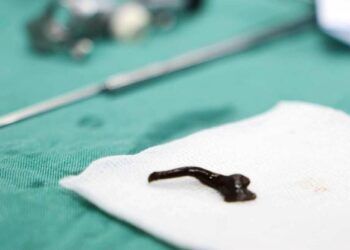 Ho ra máu, bé trai nhập viện mới phát hiện vắt bám trong đường thở