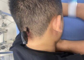 Kinh hoàng nam thanh niên bị chìa khóa cắm xuyên xương sọ