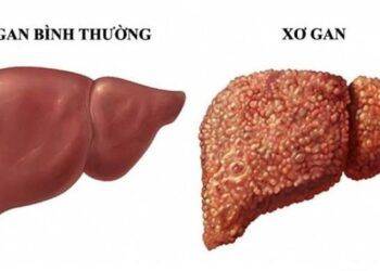 Những dấu hiệu gan đang 'kêu cứu', cần thải độc và điều chỉnh thói quen sống ngay lập tức