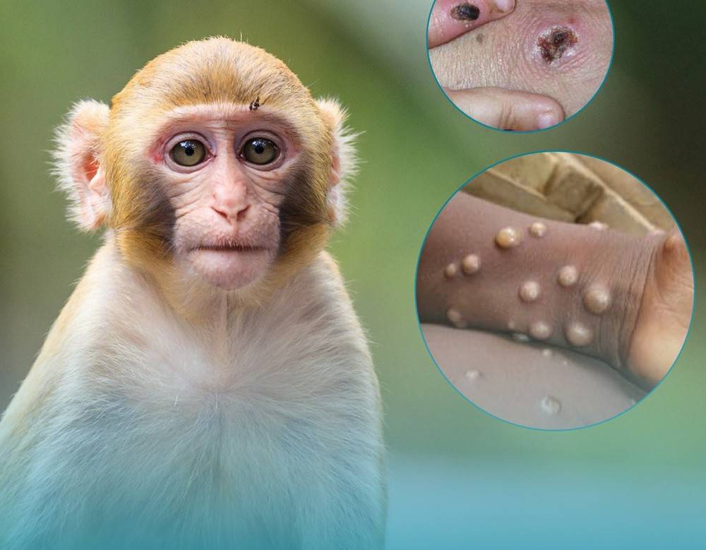 Nóng: Bộ Y tế ban hành hướng dẫn chẩn đoán, điều trị và phòng bệnh đậu mùa khỉ ở người