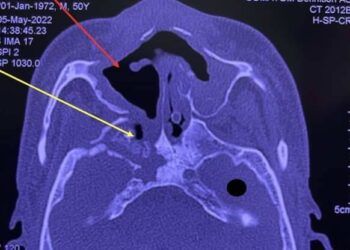 Thêm nhiều người hoại tử xương hàm sau mắc Covid