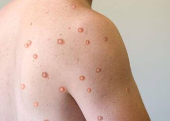 TP HCM tăng cường triển khai các giải pháp giám sát bệnh đậu mùa khỉ