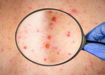 5 câu hỏi thường gặp về bệnh đậu mùa khỉ