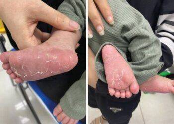 Bé trai 46 ngày tuổi mắc bệnh giang mai bẩm sinh