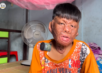 Cậu bé được ủng hộ hơn 1 tỷ khi bị bỏng vì cứu mẹ nuôi "vui đến mất ngủ"