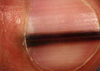 Dấu hiệu nhận biết ung thư tế bào hắc tố ở móng tay