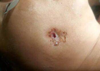 Hy hữu: Bệnh nhân bị... thủng má do biến chứng răng số 48 mọc lệch