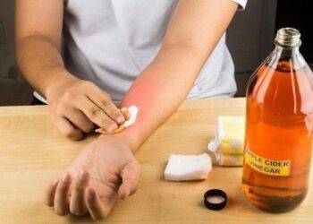 Mẹo chữa bỏng ớt hiệu quả nhanh chóng, an toàn