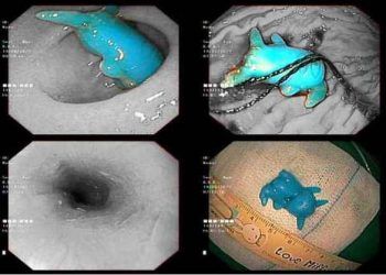 TP.HCM: Bé trai 6 tuổi nuốt đồ chơi pikachu vào bụng, phải nội soi cấp cứu