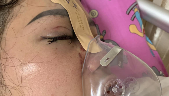 Mù mắt vì tiêm filler nâng mũi tại spa Mù mắt vì tiêm filler nâng mũi tại spa