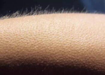 Vì sao cơ thể người “nổi da gà” khi lạnh?