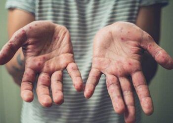 Ca mắc đậu mùa khỉ đầu tiên tại Việt Nam được phát hiện như thế nào?