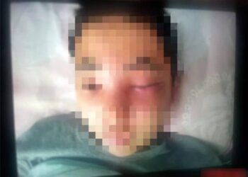 Cậu bé 13 tuổi bị viêm màng não do nặn mụn ở mũi, BS cảnh báo tuyệt đối không đụng vào vùng 'tam giác tử thần' trên khuôn mặt