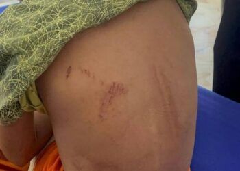 chau be lop 3 bi cha dung xang va rom dot Bố dùng xăng và rơm đốt con trai lớp 3 vì nghi con mình trộm tiền Cháu bé lớp 3 bị cha dùng xăng và rơm đốt