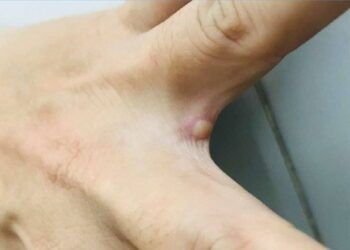 Hình ảnh vết mụn nước ở người mắc đậu mùa khỉ đầu tiên của Việt Nam