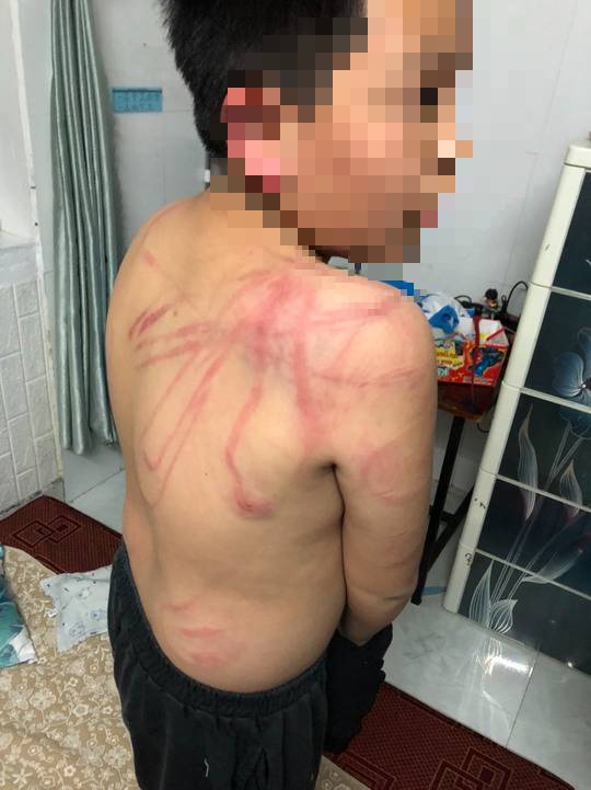 Lãnh đạo TP Đà Lạt thăm hỏi cháu trai 10 tuổi bị cha bạo hành dã man