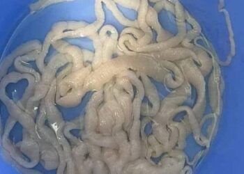 Quảng Nam: Sán xơ mít dài 10m được lấy ra từ cơ thể 1 bệnh nhân nam