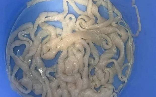 Quảng Nam: Sán xơ mít dài 10m được lấy ra từ cơ thể 1 bệnh nhân nam