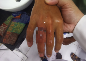 Suýt hoại tử ngón tay vì... đeo nhẫn