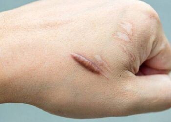 Vì sao ăn rau muống lại gây sẹo lồi và lưu ý của chuyên gia để tiêu thụ loại rau này an toàn