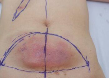 Vợ giấu chồng đi "đánh mỡ bụng", một tháng sau vào viện với vài chục ổ áp xe to như quả táo