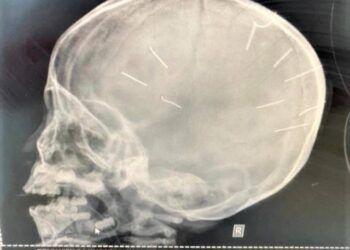 Vụ đóng 9 chiếc đinh vào đầu bé gái: 5 lần ra tay tàn độc của 'bố dượng'