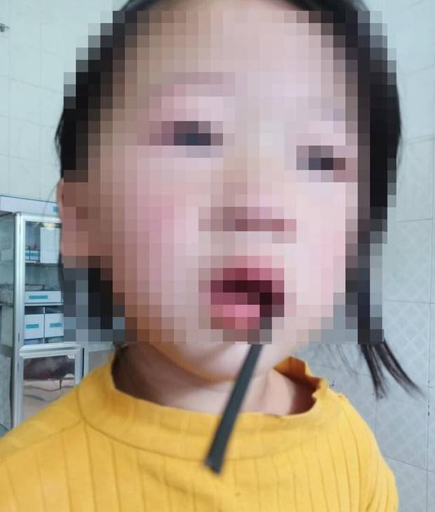 Bé gái 4 tuổi bị thanh sắt dài 20cm đâm vào khoang miệng