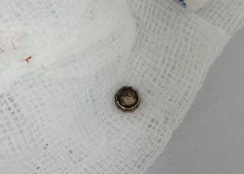 Bé gái suýt hoại tử mũi vì pin đồ chơi