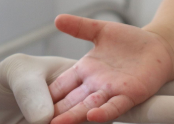 cach phong tranh cac benh truyen nhiem thuong gap khi giao mua Cách phòng tránh các bệnh truyền nhiễm khi thời tiết giao mùa Cách phòng tránh các bệnh truyền nhiễm thường gặp khi giao mùa