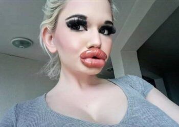 Cô gái tiêm môi 32 lần bất chấp nguy hiểm tính mạng