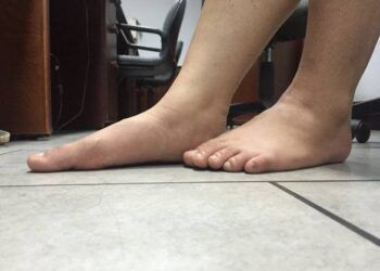 Đi giày dép từ bé dẫn đến tật bàn chân bẹt, có đúng không?