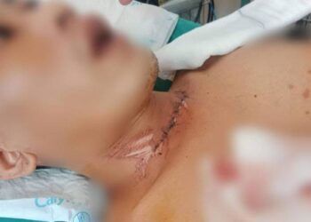 Hãi hùng nam thanh niên bị dây diều cứa cổ khi đang chạy xe máy trên đường