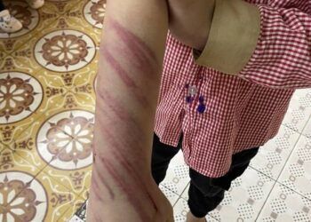 Hải Phòng: Học sinh lớp 2 nghi bị bạn trai của mẹ đánh đập, bầm tím khắp người