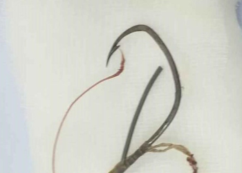 Hy hữu: Ăn cá bị hóc lưỡi câu