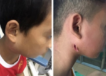 phat hien 3 ca mac whitmore tai thanh hoa dak lak bo y te ra cong van khan Bộ Y tế ra công văn khẩn khi phát hiện 3 ca mắc vi khuẩn ăn thịt người tại Thanh Hóa, Đắk Lắk Phát hiện 3 ca mắc Whitmore tại Thanh Hóa, Đắk Lắk, Bộ Y tế ra công văn khẩn