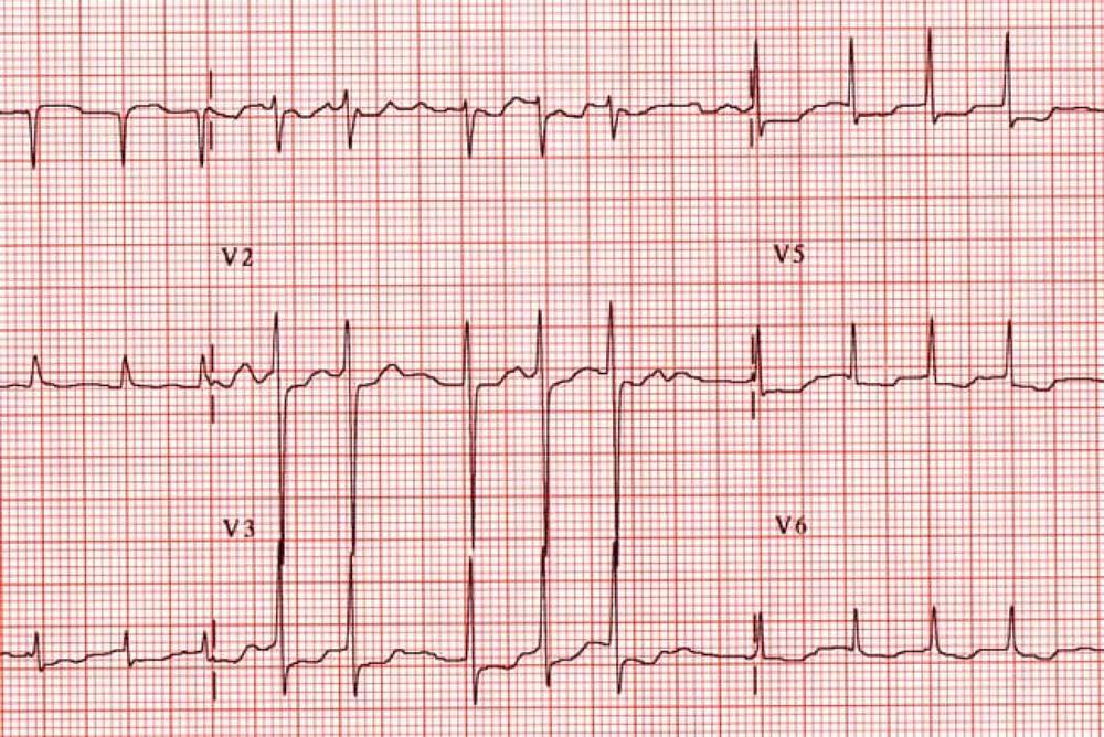 Quá trình lão hóa khiến nguy cơ mắc bệnh tim tăng lên?